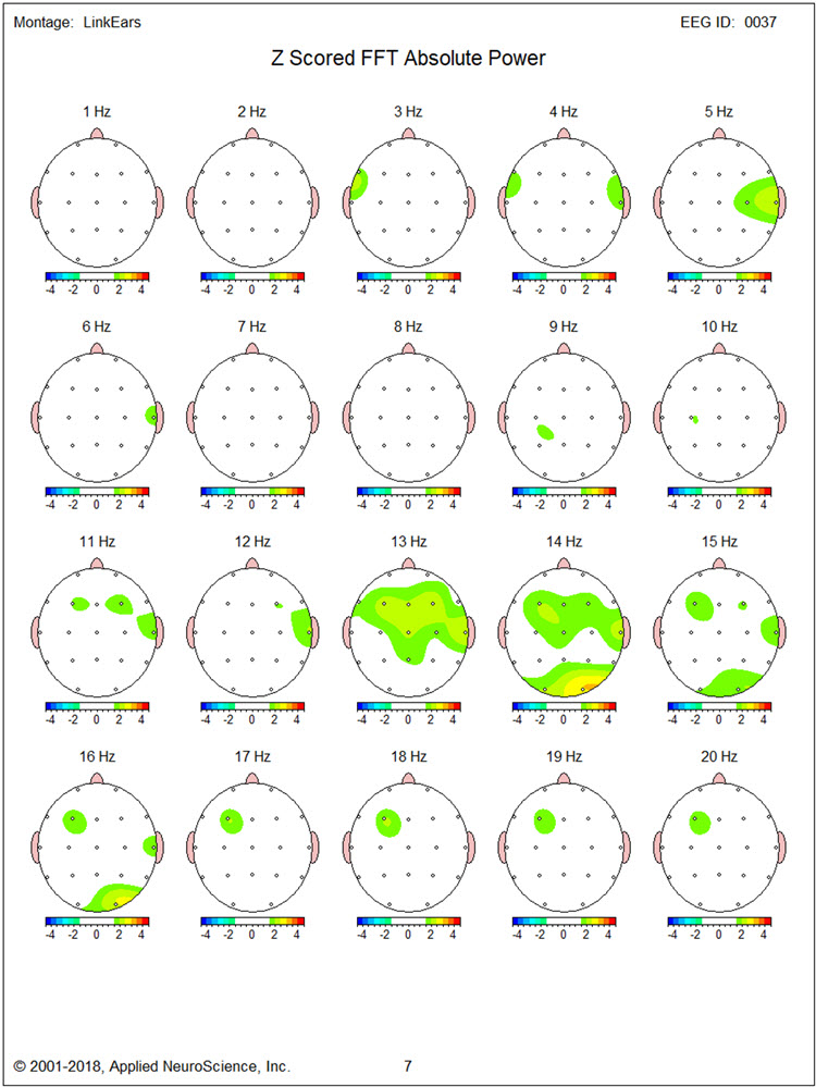 Figure 24 - Post-neurofeedback eyes-open z-score FFT absolute power single-Hz bins 1-20 Hz